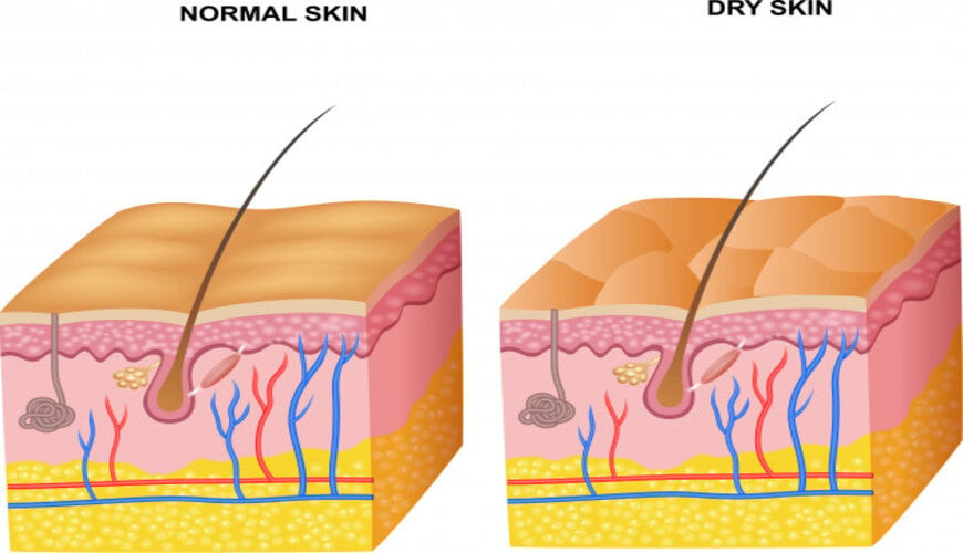Nguyên nhân gây khô da và cách chăm sóc da khô hiệu quả, an toàn