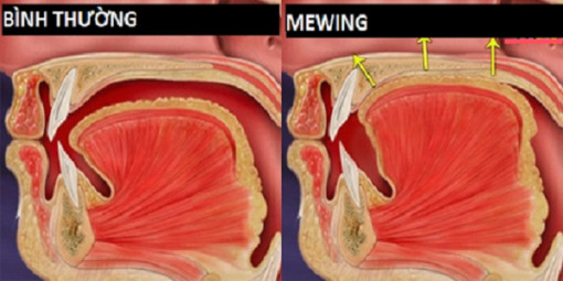 Hướng dẫn tập Mewing