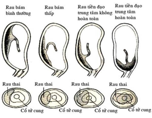 Nhau thai bám thấp có gây sảy thai, sinh non?