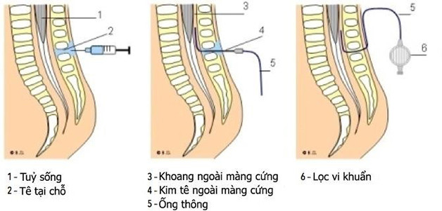 CÁCH GIẢM ĐAU KHI SINH HIỆU QUẢ GIÚP MẸ “VƯỢT CẠN” NHẸ NHÀNG