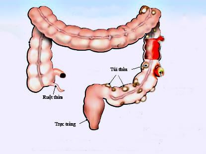 Bệnh Túi Thừa Gây Đau Vùng Xương Chậu