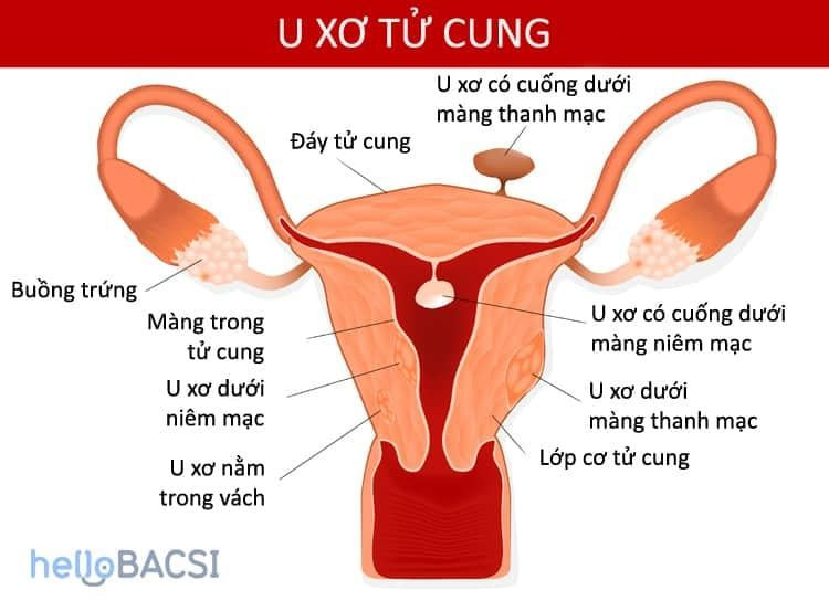 U xơ tử cung: Hiểu biết cần thiết và những điều cần lưu ý