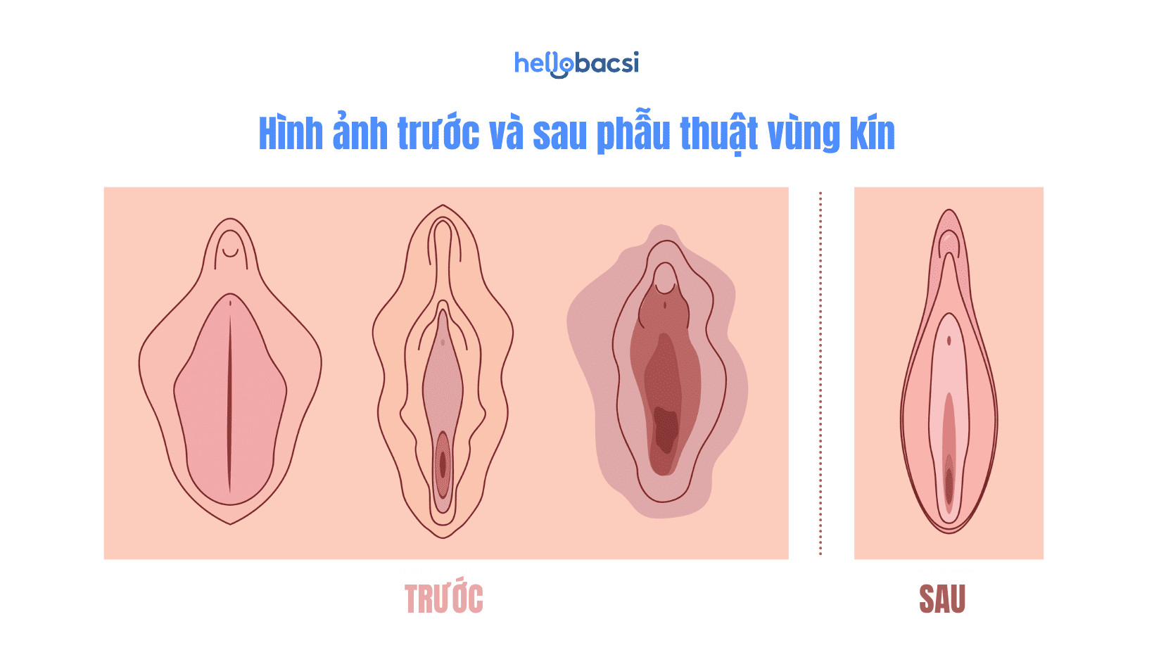 Hình ảnh phẫu thuật vùng kín