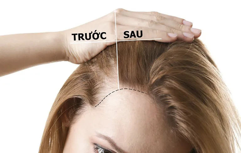 Hỗ trợ mọc tóc hiệu quả