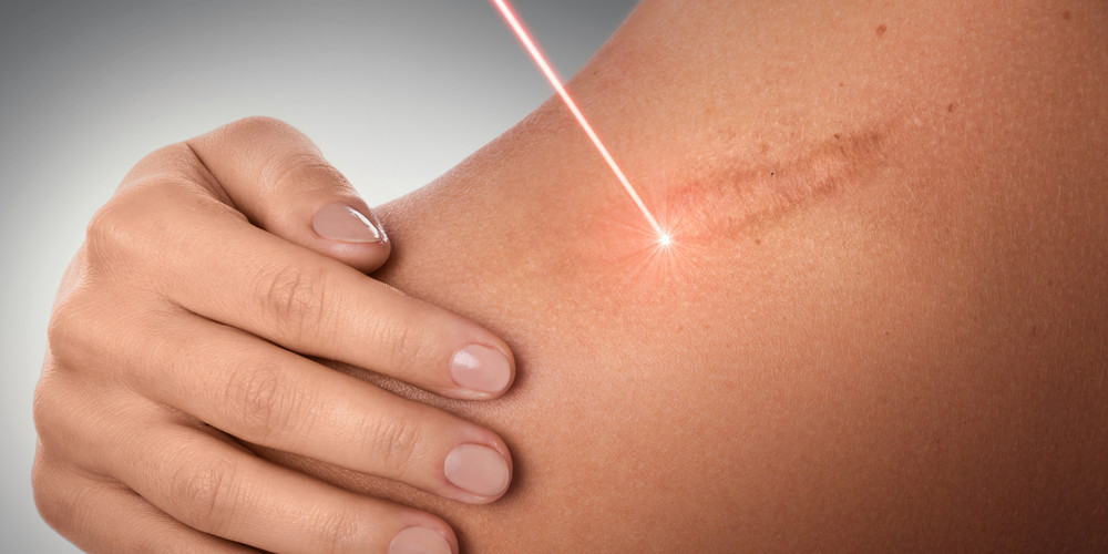 Laser trị sẹo thâm