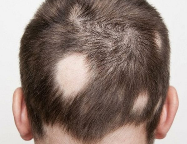 Rụng tóc có sẹo (Scarring Alopecia)