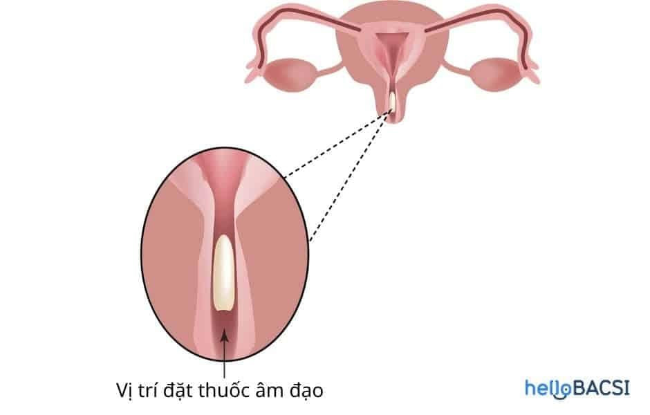 Vệ sinh vùng kín đúng cách sau khi đặt thuốc âm đạo