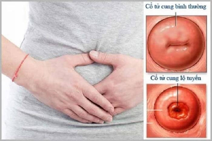 So sánh cổ tử cung bình thường và cổ tử cung lộ tuyến