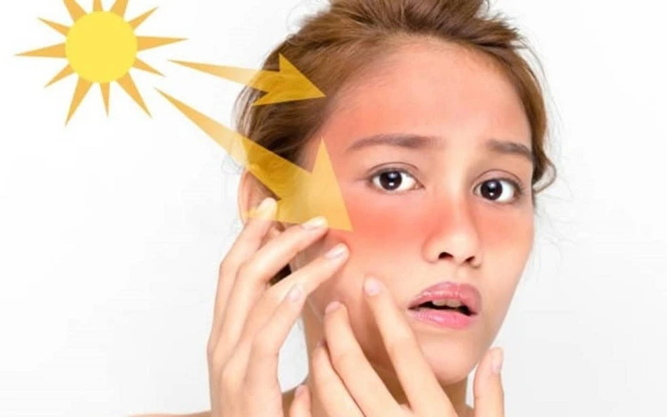 Ánh nắng gây nám tàn nhang