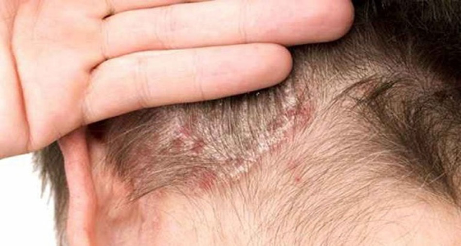 Bệnh lý ảnh hưởng đến gàu