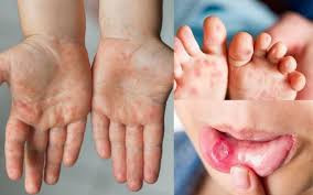 Bệnh tay chân miệng ở trẻ em mùa hè