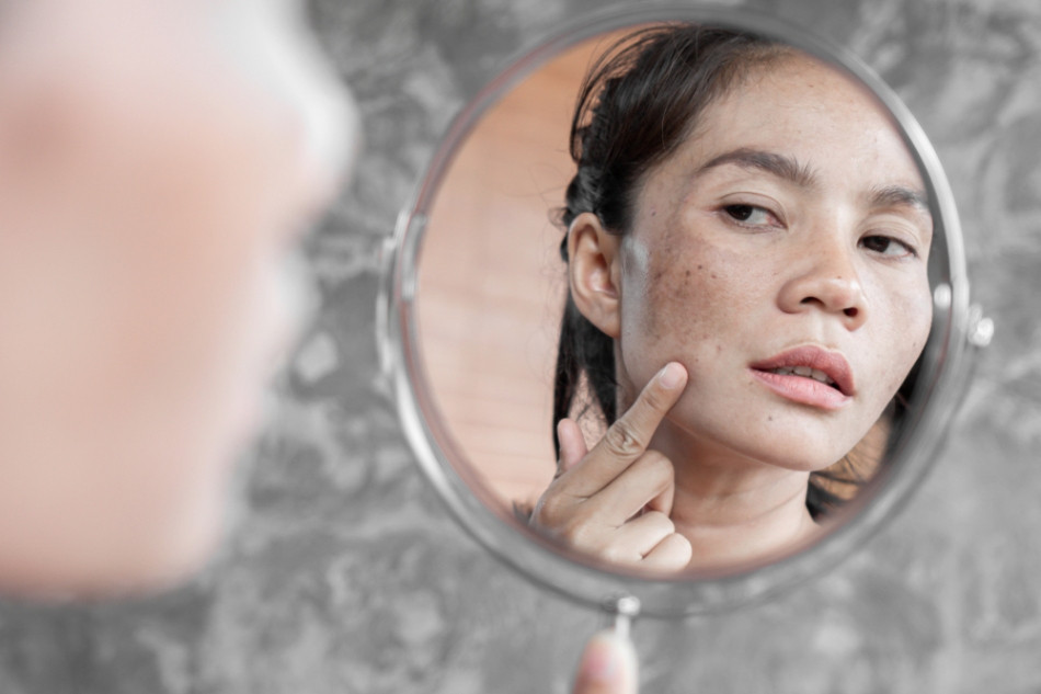 Bị nám khi mang thai xong có tự hết không?