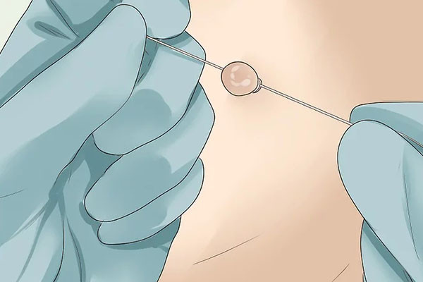Bóc tách mụn thịt