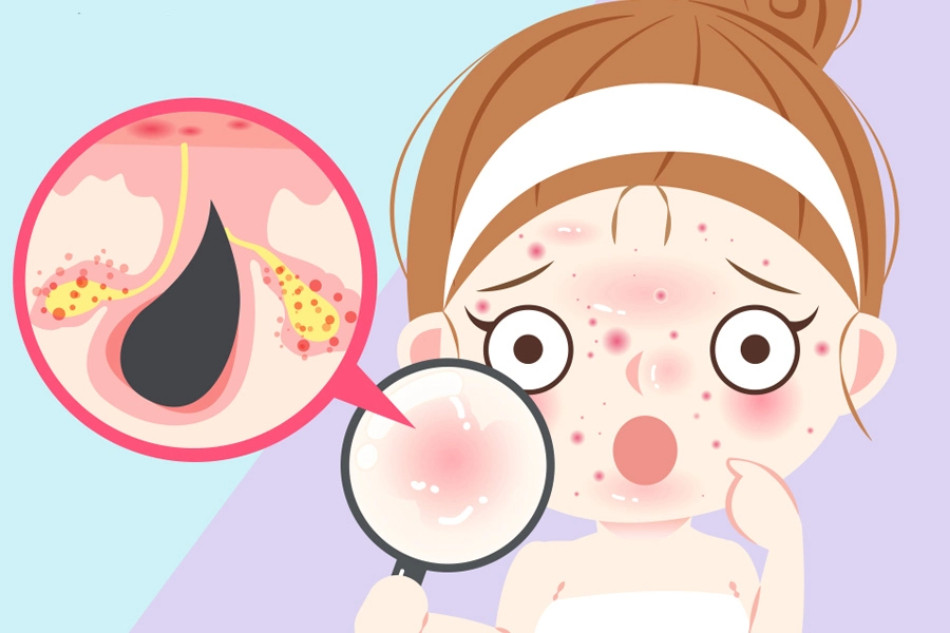 Các điều cần làm khi bị mụn
