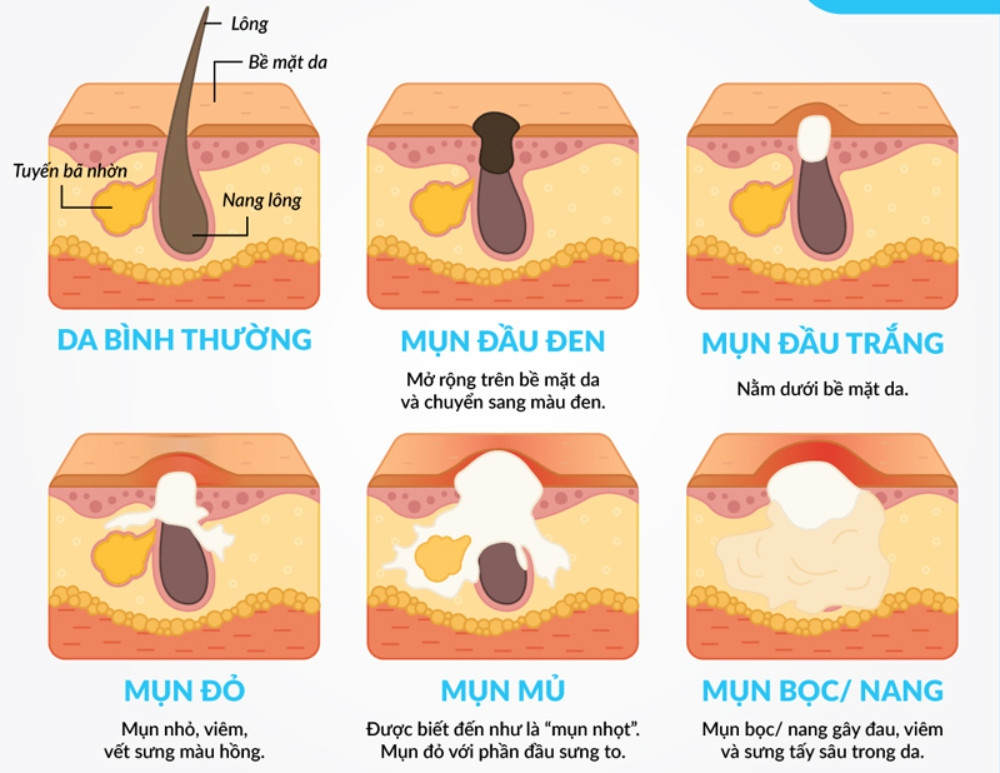Các loại mụn trên lưng