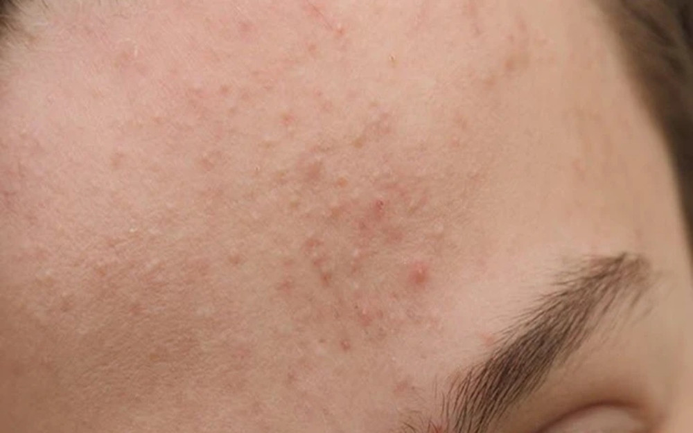 Cách chăm sóc da mụn ẩn hiệu quả