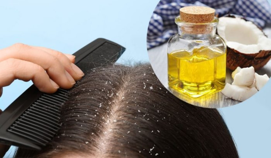 Cách trị hết gàu với dầu dừa