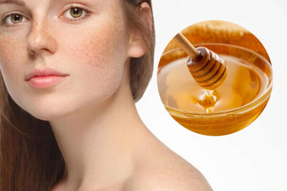 Cách trị nám gò má hiệu quả bằng mật ong