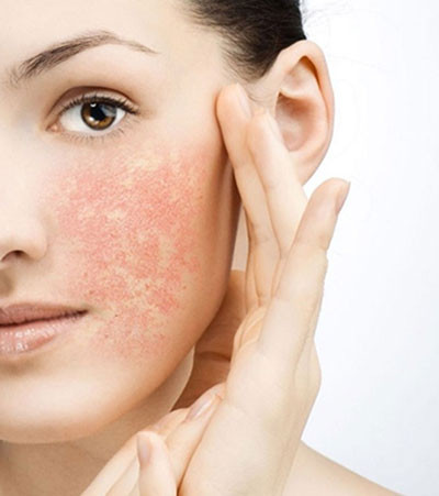 Cách xử lý da bị kích ứng
