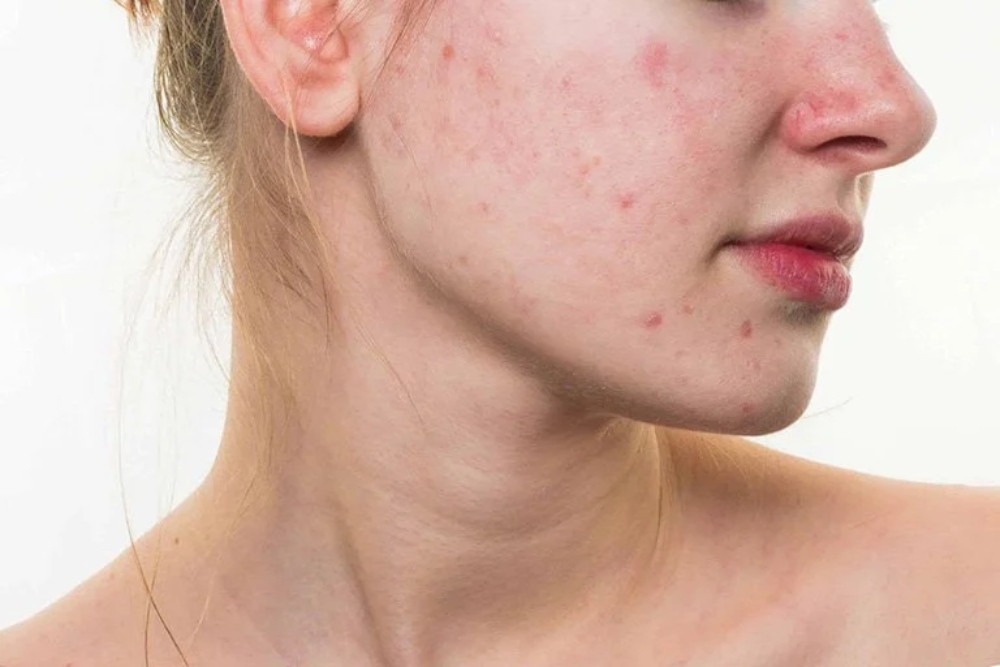 Cách xử lý nếu bị kích ứng sau khi sử dụng nghệ và mật ong
