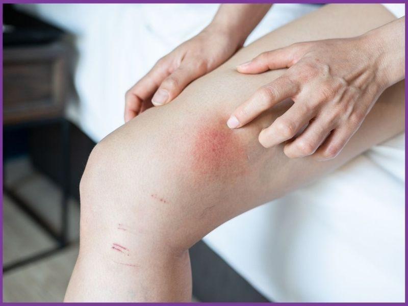 Chafing là gì? Mẹo nhận biết và hạn chế chafing khi chạy bộ