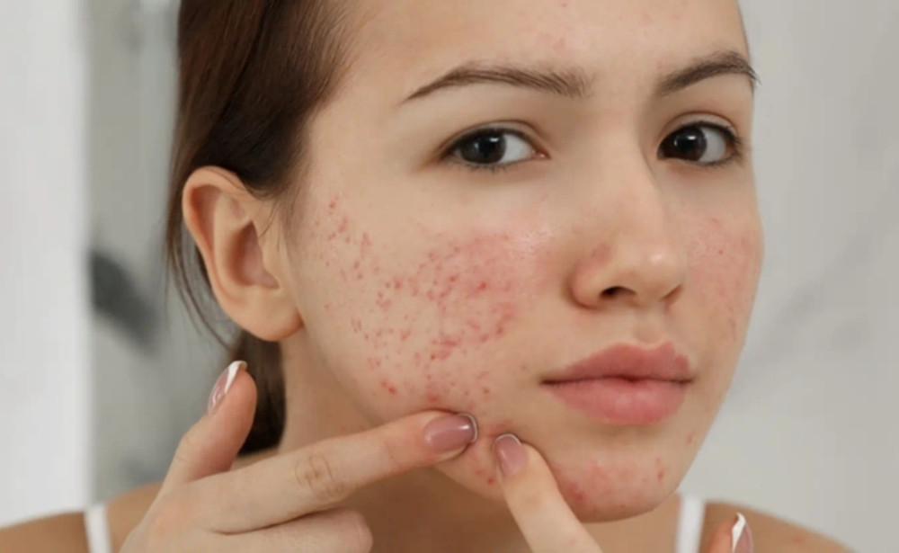 Chăm sóc da mụn giúp lớp trang điểm hoàn hảo hơn