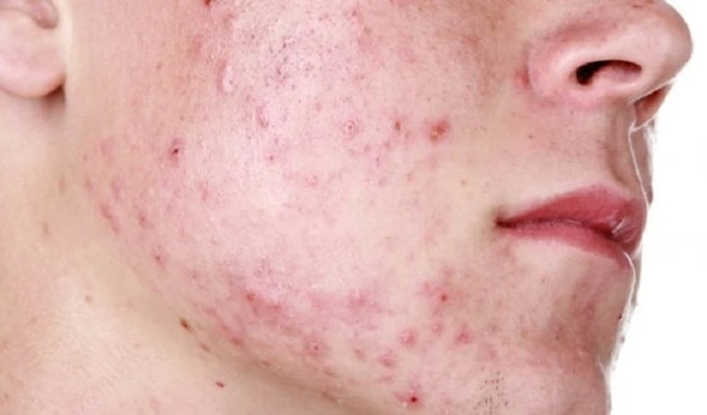 Chăm sóc da mụn viêm với quy trình đặc biệt