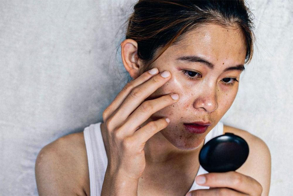Cháy nắng gây nám và sạm da
