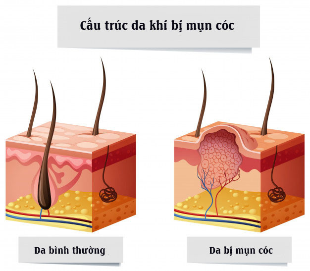 Cơ chế hình thành và cấu trúc da khi bị mụn cóc