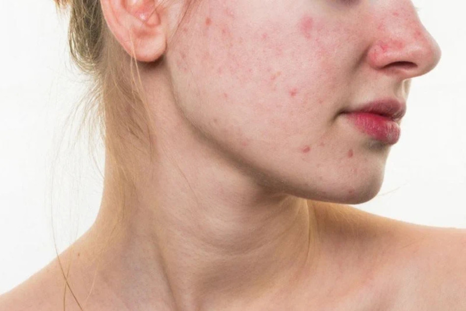 11 Cách Giữ Da Mặt Không Bị Mụn Hiệu Quả Dành Cho Bạn