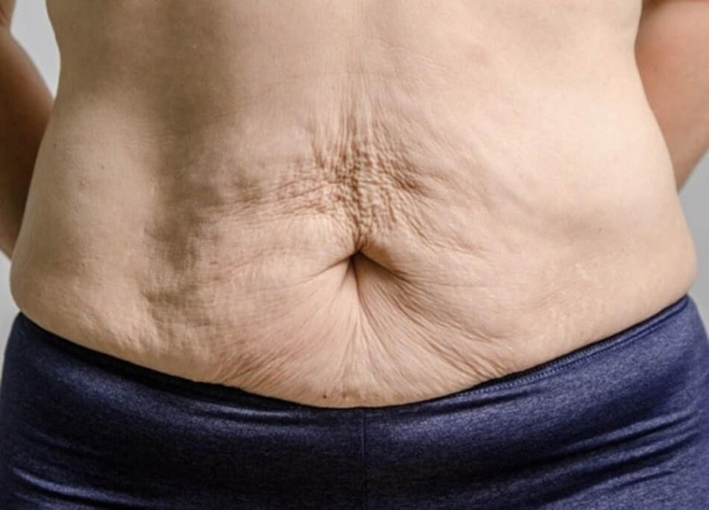 Da bị chảy xệ, nhăn nheo khiến chị em già nua và mất tự tin đi