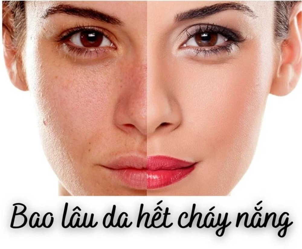 Da cháy nắng mất bao lâu để phục hồi hoàn toàn?