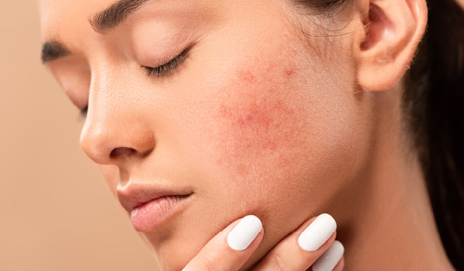 Top 13 Sữa Rửa Mặt Dành Cho Da Dầu Mụn Nhạy Cảm Hiện Nay