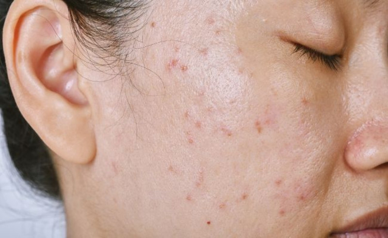 Cách Chăm Sóc Da Dầu Mụn Hiệu Quả: 8 Bước Đơn Giản Giúp Phục Hồi Nhanh Chóng