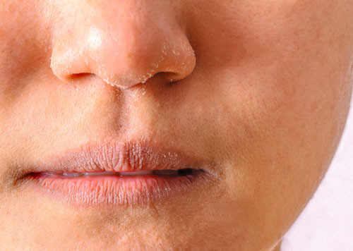 Da hỗn hợp vào mùa đông