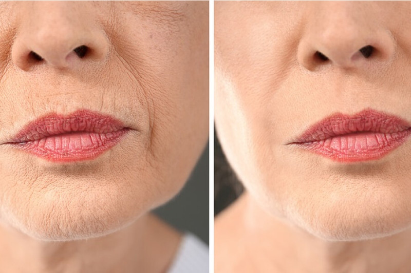 Da kém đàn hồi, bị chảy xệ khi bị lão hóa