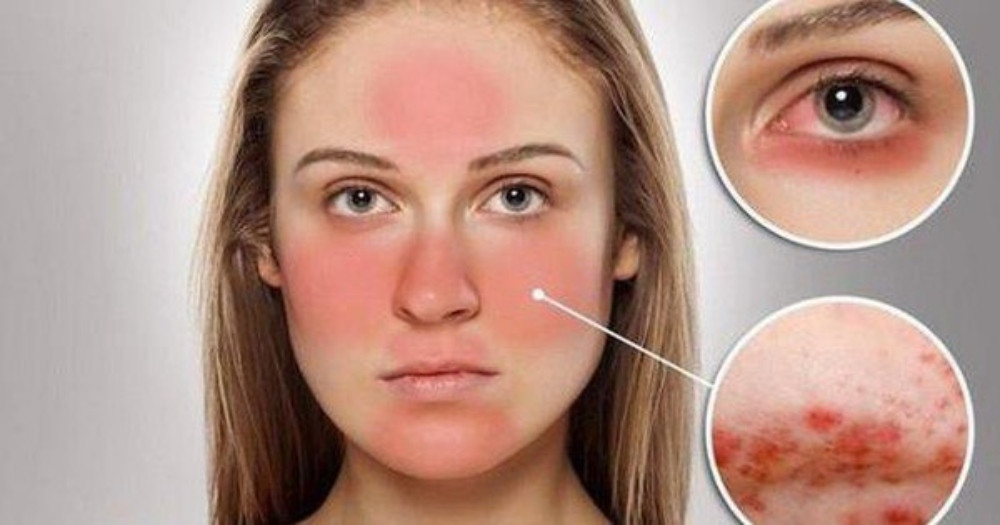 Da ở vùng chữ T rất dễ bị nhạy cảm và kích ứng khi sử dụng sản phẩm không phù hợp.