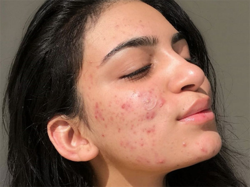 Đặc điểm của làn da mụn