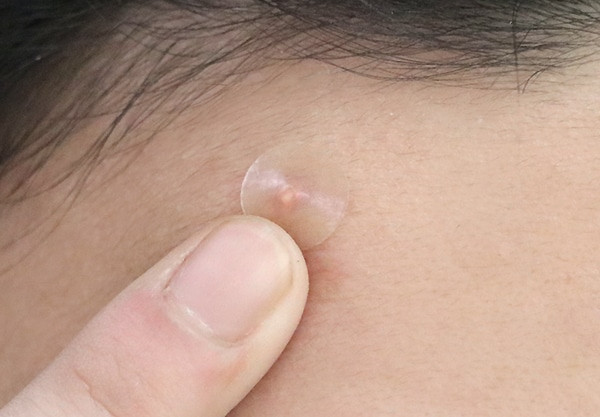 Dán nhãn trị mụn
