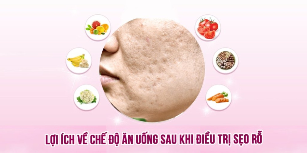 Danh sách thực phẩm nên ăn và hạn chế sau trị sẹo rỗ