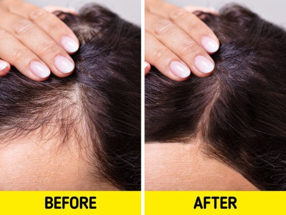 Dầu dừa giúp kích thích tóc mọc nhanh