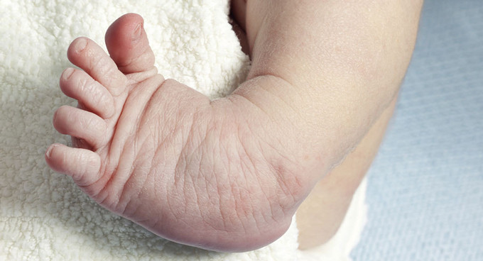 Dấu hiệu khoèo chân ở trẻ