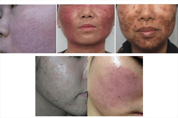Dấu hiệu muộn của da bị nhiễm độc