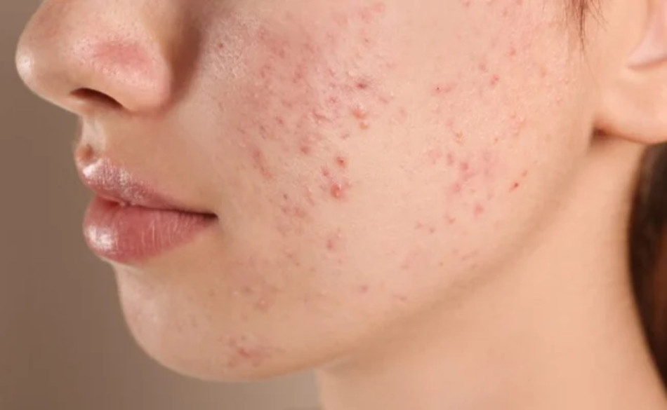 Da Dầu Mụn: Hướng Dẫn Chăm Sóc Đặc Biệt Để Kiểm Soát Dầu Thừa và Ngăn Chặn Mụn Phát Triển