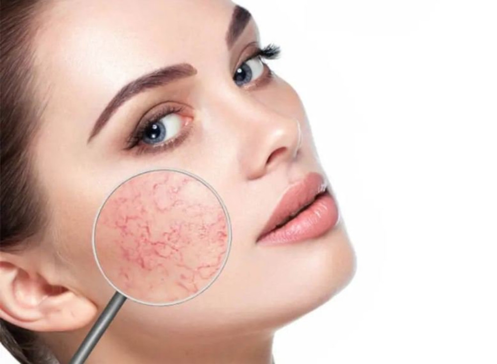 Dấu hiệu nhận biết làn da yếu mỏng