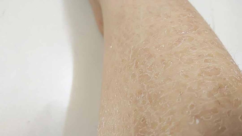 Cách Nhận Biết và Khắc Phục Tình Trạng Da Chân Bị Tróc Vảy Trắng
