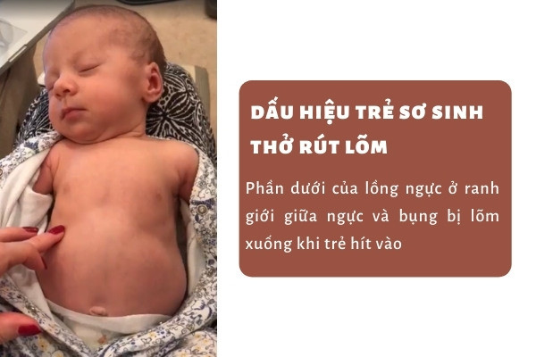 Dấu hiệu trẻ bị viêm phổi dễ nhận biết