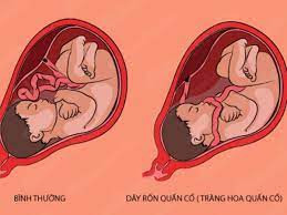 Vấn đề về dây rốn mà mẹ bầu cần chú ý quan tâm