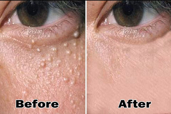 Điều trị bằng công nghệ cao Plasma