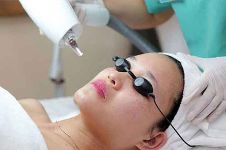Điều trị nám bằng laser